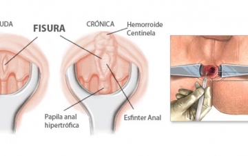 Fisura anal tratamiento | Tipos de fisuras anales